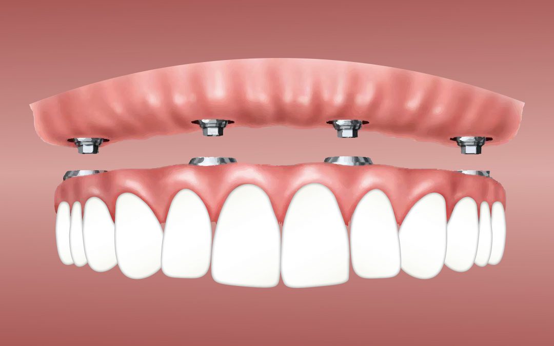 Wat te verwachten tijdens het plaatsen van tandheelkundige implantaten