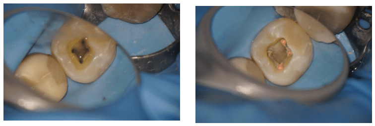 Wat is het verschil tussen een tandarts en een endodontist?